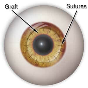 Corneal Transplant