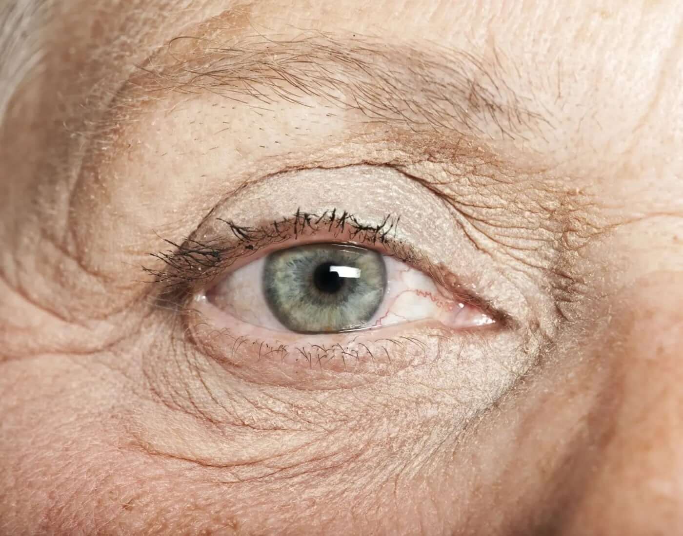 Pterygium